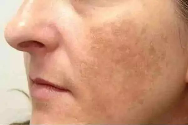 ودّعي كنف الوجه بعد الولادة... خلطة سحرية تعيد لبشرتك صفاءها الطبيعي