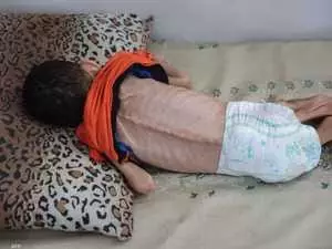 غزة تحتضر ببطء..الجوع ينهش الأجساد والدواء حلم مستحيل