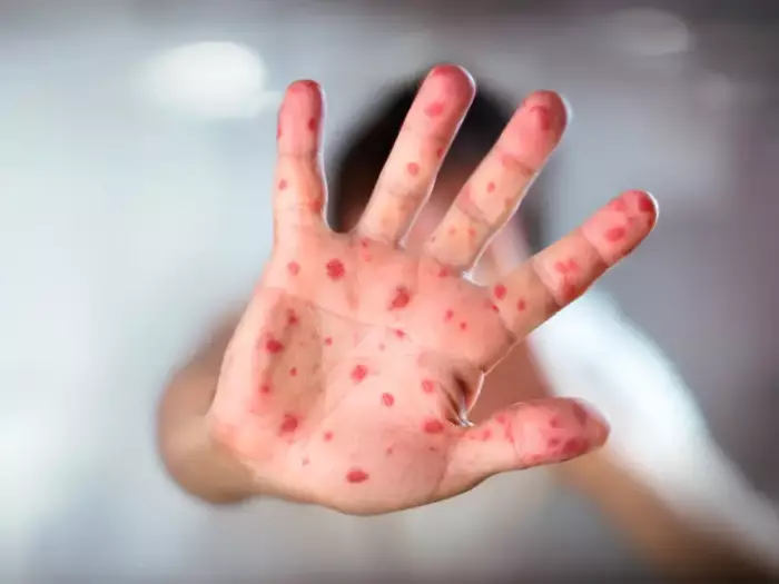 الحصبة تضرب أمريكا بقوة ونحو 3900 إصابة في أسوأ تفشٍ منذ أكثر من ثلاثة عقود