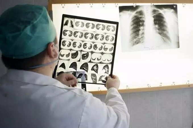 53  بالمائة من إصابات السل خارج الرئة تدق ناقوس الخطر بالمغرب