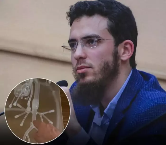 الدكتور "يوسف العزوزي" يهز الأوساط الطبية باختراع عالمي غير مسبوق لتصفية الدم من داخل الأوعية الدموية